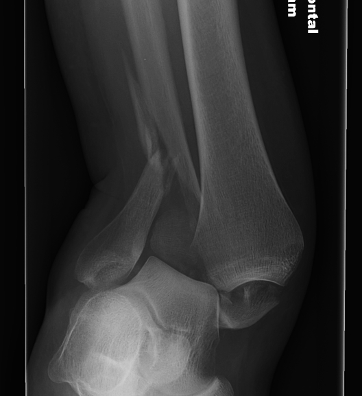 Ankle Fracture Severely Dislocated 